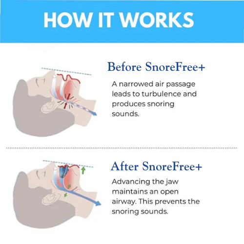 SnoreFree+ Anti Snoring Mouthpiece Universal Size