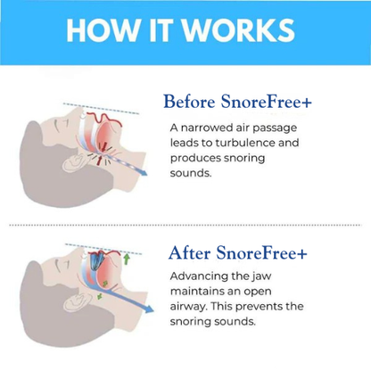 SnoreFree+ Anti Snoring Mouthpiece Universal Size